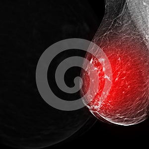 X-ray Digital Mammogram or mammography of both side breast Standard views are  mediolateral oblique (MLO) views