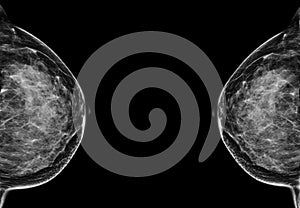 X-ray Digital Mammogram or mammography of the breast CC view