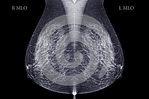 X-ray Digital Mammogram or mammography  image MLO view.