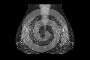 X-ray Digital Mammogram or mammography  image MLO view .