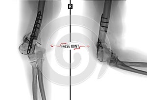 X-ray of the elbow joint. False joint. Negative. Marker.