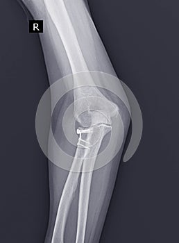 X-ray Elbow joint.After open reduction and internal fixation for radial head with Leibinger plate and repair of lateral ulnar