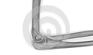 X-ray Elbow or Radiography of Right elbow.