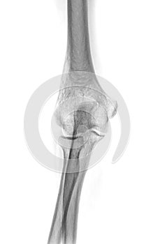 X-ray Elbow or Radiography of Right elbow AP view .