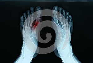 X ray of feet with tarsal fracture closeup