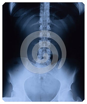 X-RAY of female lower thorax and pelvis photo