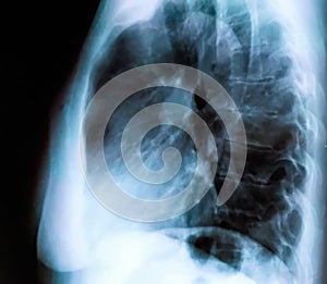 X-ray of a female patient`s lungs with pronounced traces of the inflammatory process