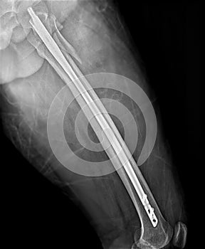 X-ray femur bone Fracture After Total Hip Replacement