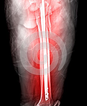 X-ray femur bone Fracture After Total Hip  Replacement