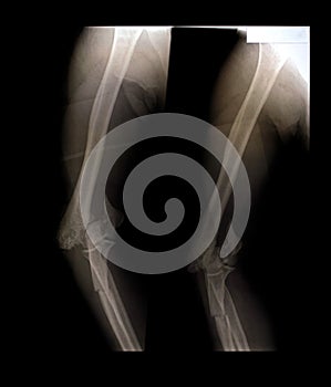 An X-ray film of the arm fracture in an accident for diagnosis in the treatment of diseases X-ray film images taken from the x-ray