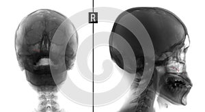 X-ray film of the face - frontal, nose-chin and lateral projection. Volume formation of the right maxillary sinus. Marker. Negativ