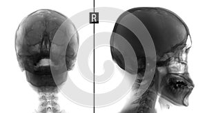 X-ray film of the face - frontal, nose-chin and lateral projection. Volume formation of the right maxillary sinus. Negativ