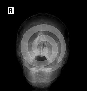 X-ray film of the face - frontal, nose-chin projection. Pansinusitis.