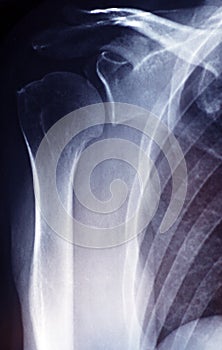 X ray film of human shoulder