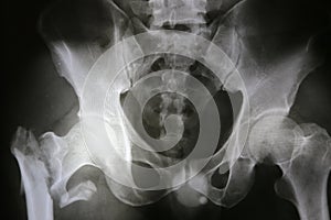 X-ray film of intrinsic hip and pelvic pain isolated on black ba