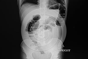 x-ray film of a patient with bowel obstruction