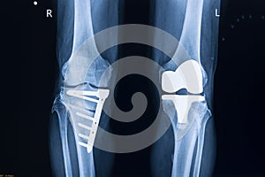 X-ray film of a patient with total left knee replacement