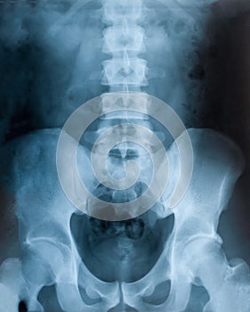 X-ray film of the pelvis, health examination