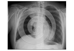 An x-ray film taken on a pair of lungs with cancerous cells photo