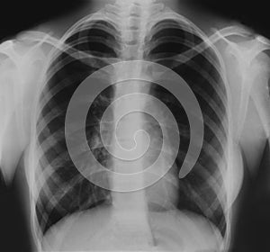 X-ray film of the teenager& x27;s thorax