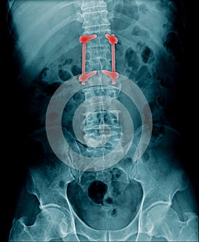 x-ray fixation lumbar