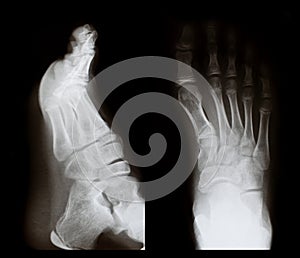 X-ray of a foot