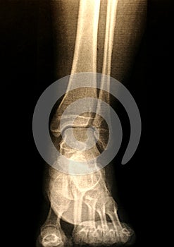 X-ray of a foot