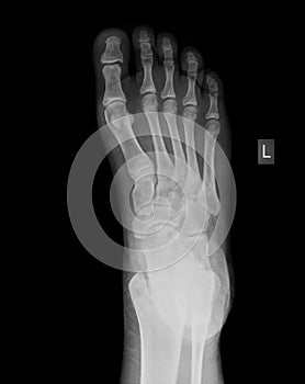 X-ray of foot