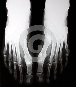 X-ray of foot