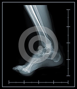 X-ray foot and ankle lateral view.