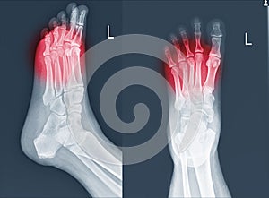 X-ray foot and ankle showing Metatarsal fractures