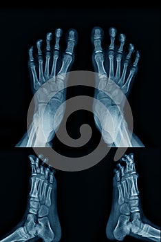 X-ray foot both side with lateral view both side