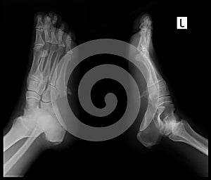 X-ray of the foot. Exostosis of the 5th metatarsal bone. Marker.