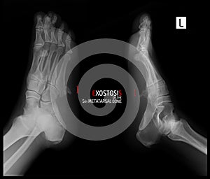 X-ray of the foot. Exostosis of the 5th metatarsal bone. Marker.