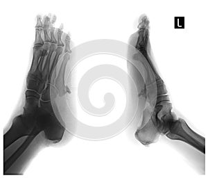 X-ray of the foot. Exostosis of the 5th metatarsal bone. Negative. photo