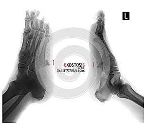 X-ray of the foot. Exostosis of the 5th metatarsal bone. Negative. Marker. photo