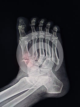 X-ray Foot Findings Fracture .