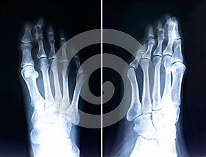 X-ray of foot fingers. Radiography with deformed toes. Hallux valg