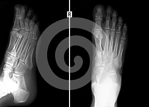 X-ray of the foot. Fracture of the 5th metatarsal bone.