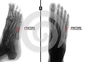 X-ray of the foot. Fracture of the 5th metatarsal bone. Marker. Negative.