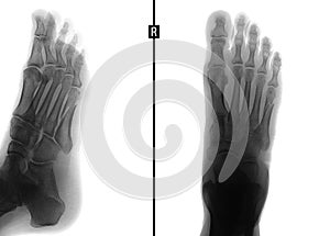 X-ray of the foot. Fracture of the 5th metatarsal bone. Negative.