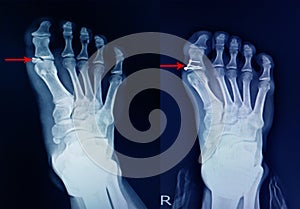 X-ray foot fracture proximal phalang and surgery fix mini plate and screws photo