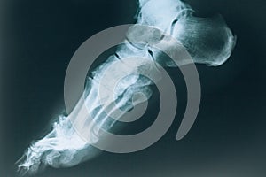 X-ray of the foot. Injury to the bones of the foot. Sports injury