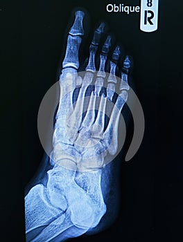 x-ray foot Oblique view showing fracture neck of metatarsal bone .