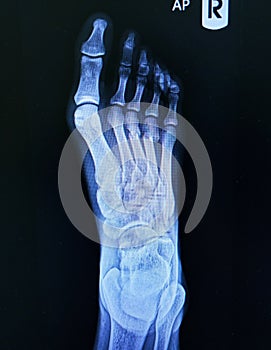 x-ray foot Oblique view showing fracture neck of metatarsal bone Medical image concept.