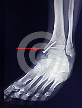 X-ray foot after operation fix screws in medial malleolus tibia. photo