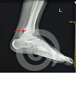 X-ray foot after operation fix screws in medial malleolus tibia photo