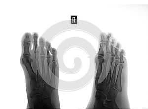 X-ray of the foot. Osteochondropathy of the 3th metatarsal bone. Negative. Marker.