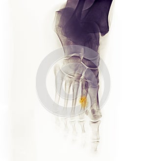 X-ray of the foot showing a healing fracture