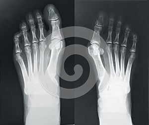 X-ray of the foots